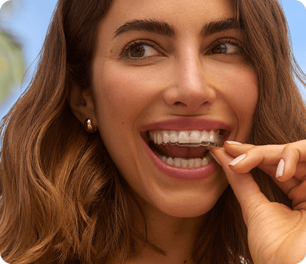 Mulher colocando o aparelho invisível SouSmile